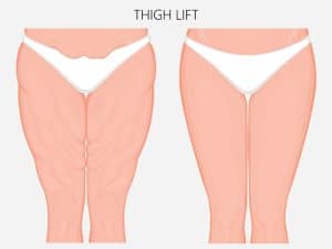 Thighplasty surgery in Granite Bay