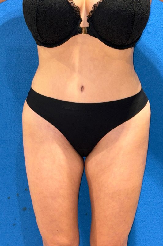 104807 Abdominoplasty LF post 1