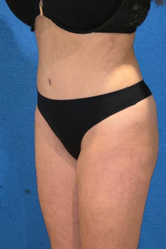 104807 Abdominoplasty LF post 4