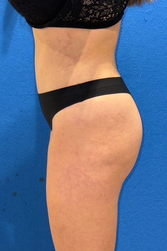 104807 Abdominoplasty LF post 5