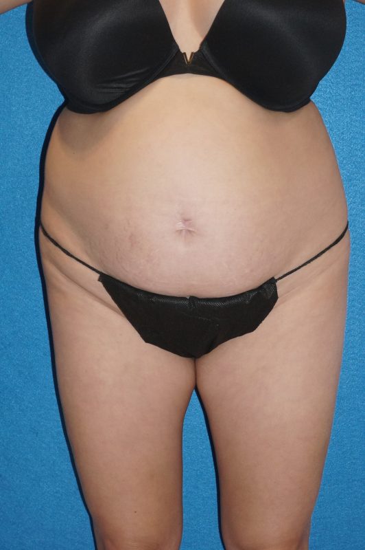 104807 Abdominoplasty LF pre 1