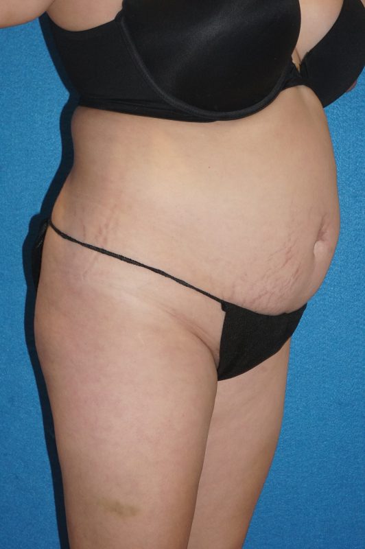 104807 Abdominoplasty LF pre 2
