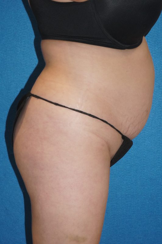 104807 Abdominoplasty LF pre 3