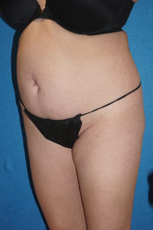 104807 Abdominoplasty LF pre 4