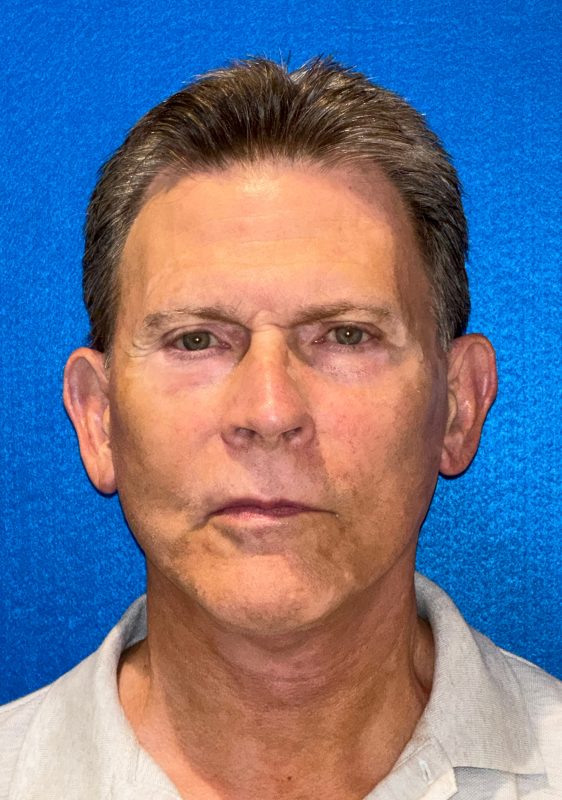 104807 facelift LA Post 1