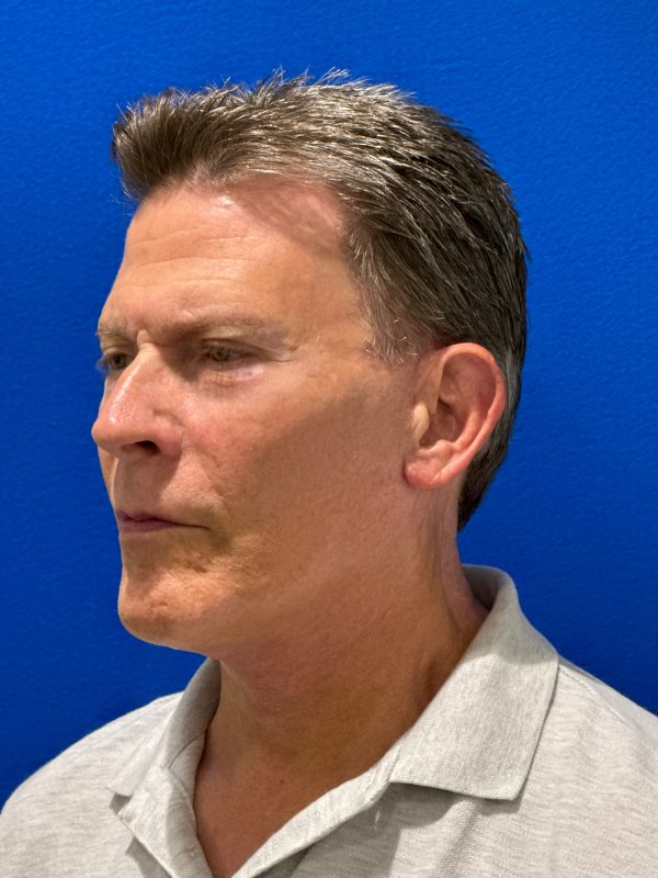 104807 facelift LA post 2