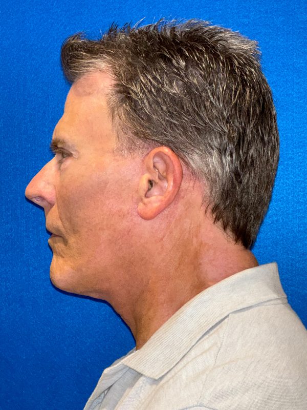 104807 facelift LA post 3