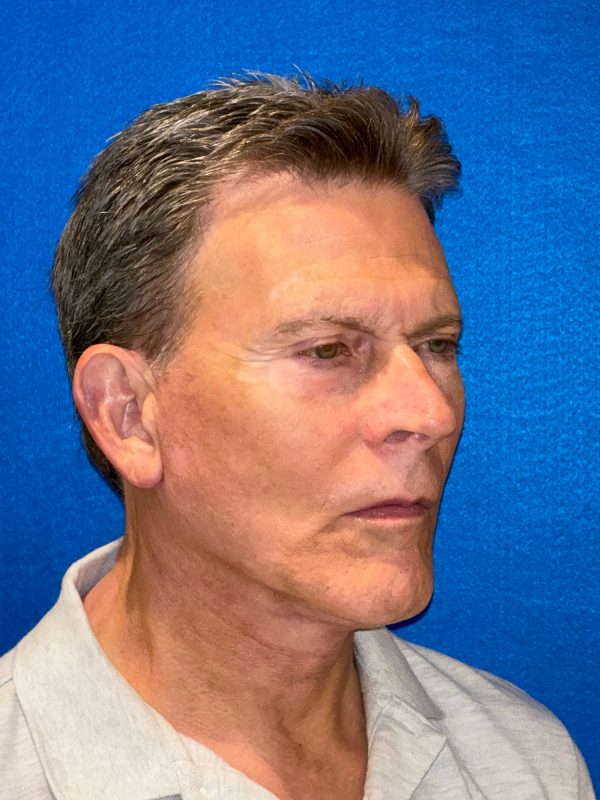 104807 facelift LA post 4