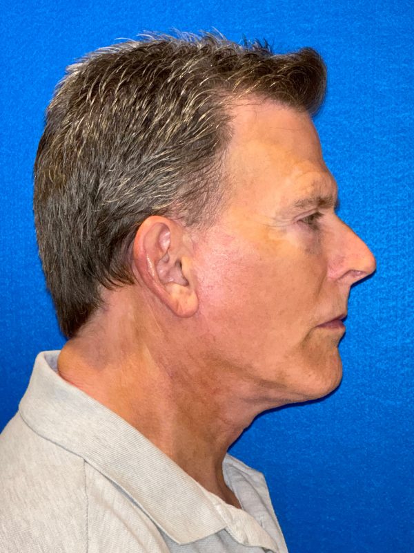 104807 facelift LA post 5