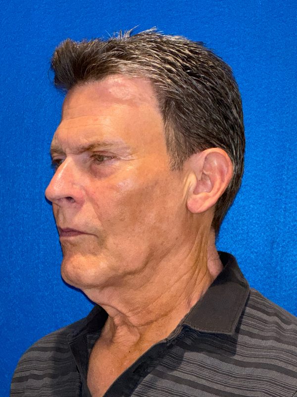 104807 facelift LA pre 2