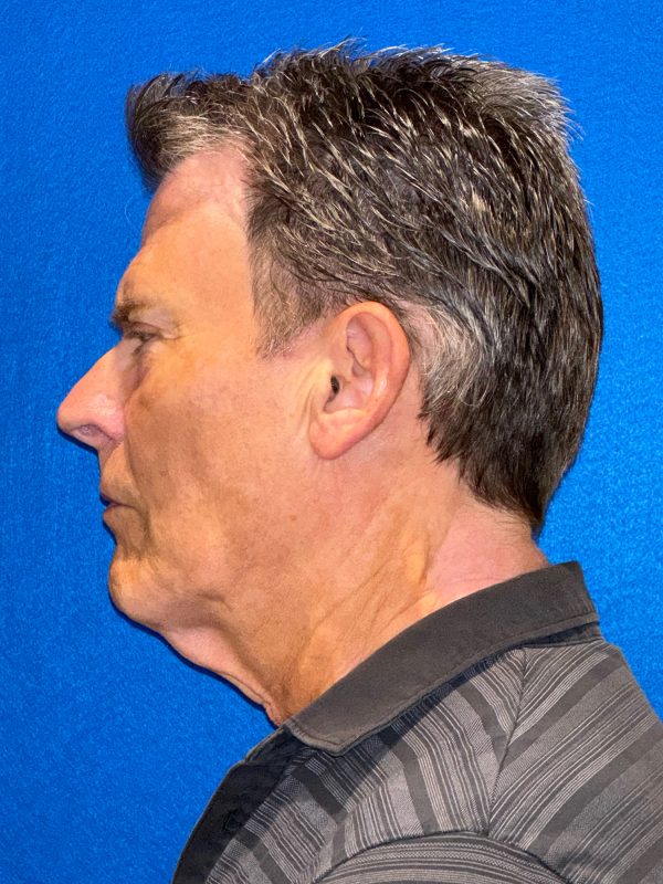 104807 facelift LA pre 3