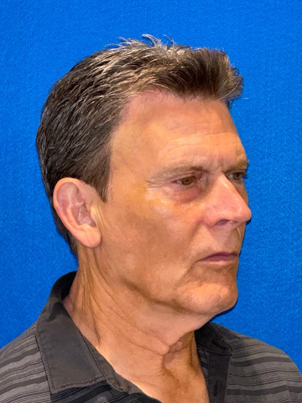 104807 facelift LA pre 4