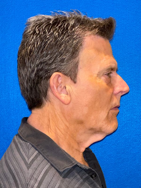 104807 facelift LA pre 5