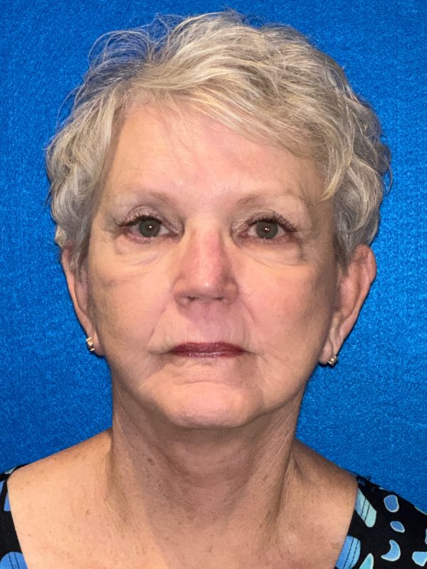 106281 Facelift c1 FH post 1