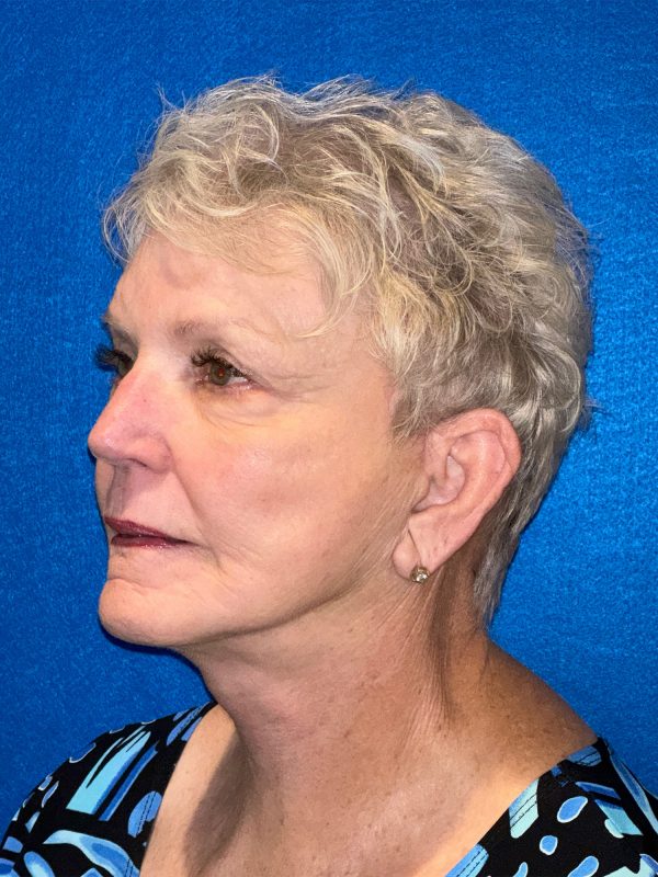 106281 Facelift c1 FH post 2