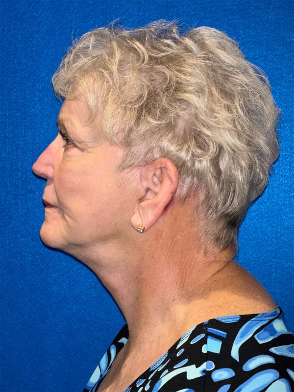 106281 Facelift c1 FH post 3