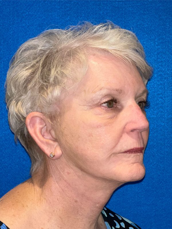 106281 Facelift c1 FH post 4