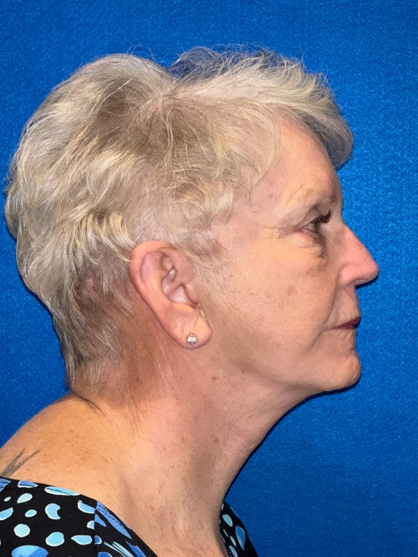 106281 Facelift c1 FH post 5