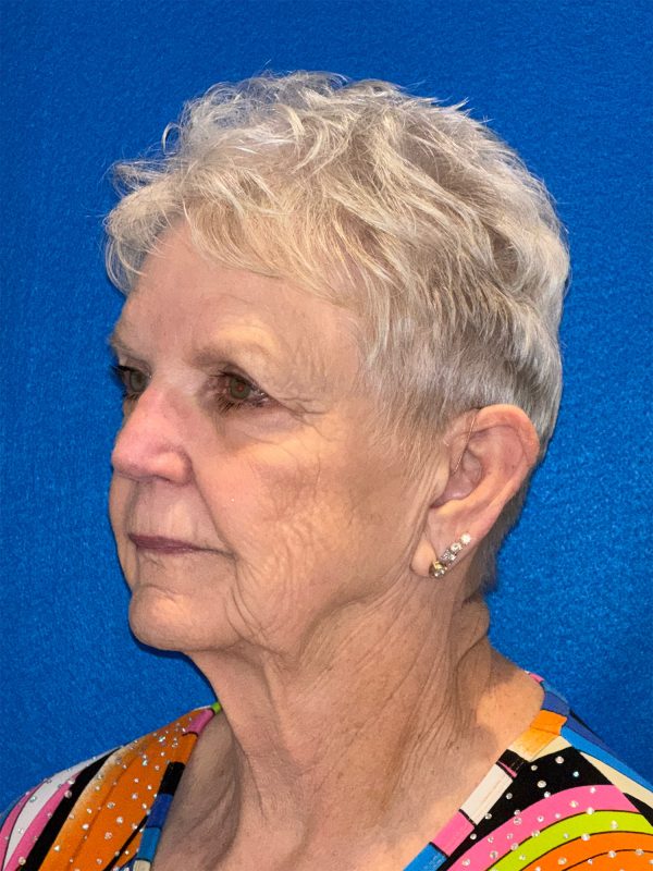 106281 Facelift c1 FH pre 2