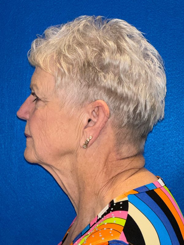 106281 Facelift c1 FH pre 3