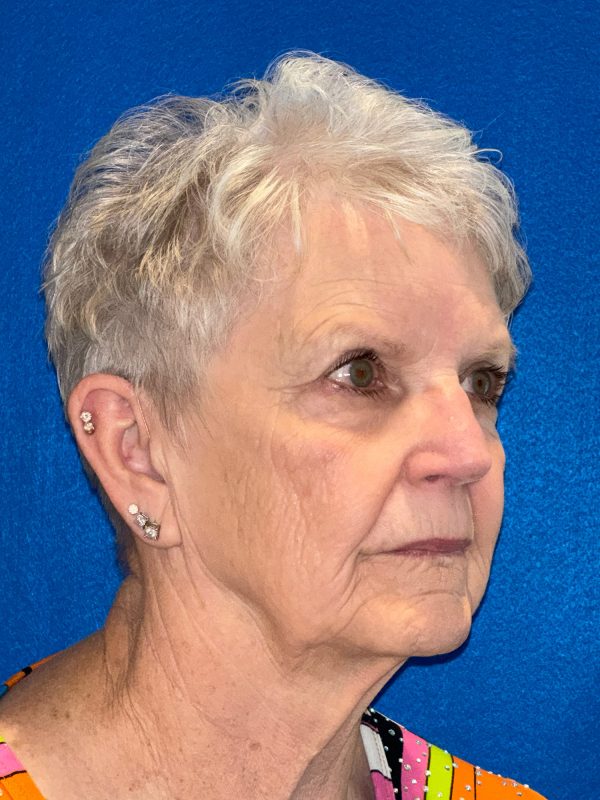 106281 Facelift c1 FH pre 4