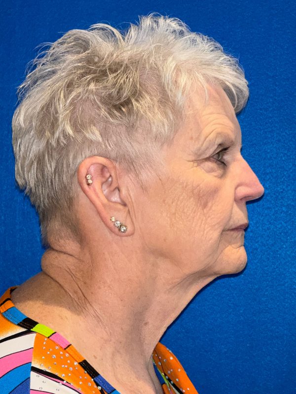 106281 Facelift c1 FH pre 5