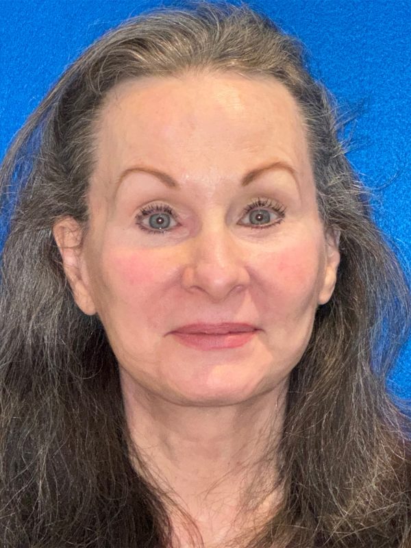 106281 Facelift c2 a1