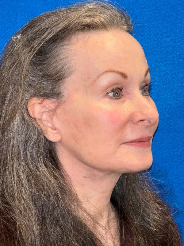 106281 Facelift c2 a2