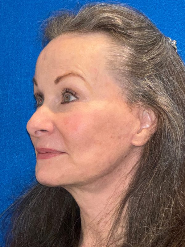 106281 Facelift c2 a4