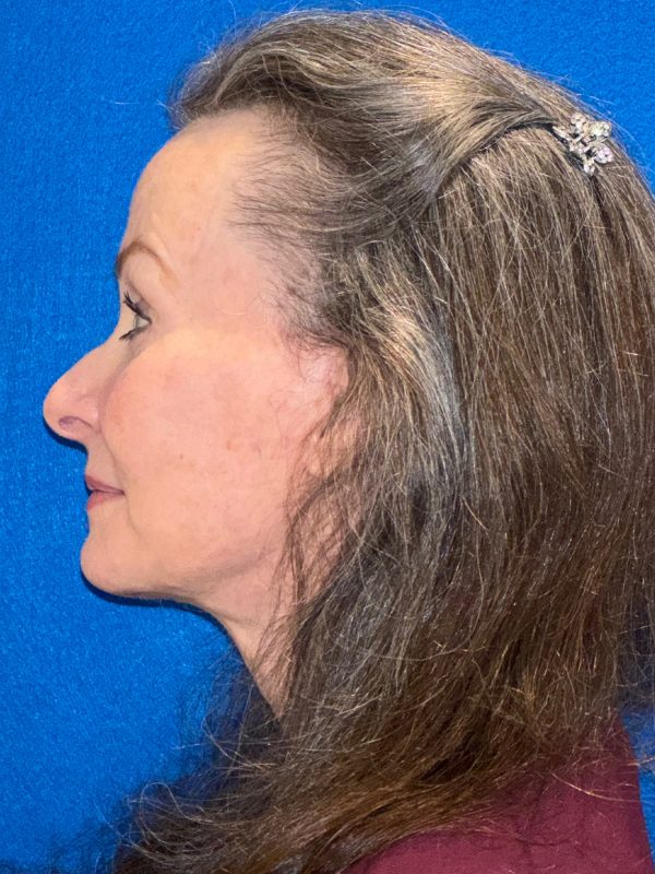 106281 Facelift c2 a5