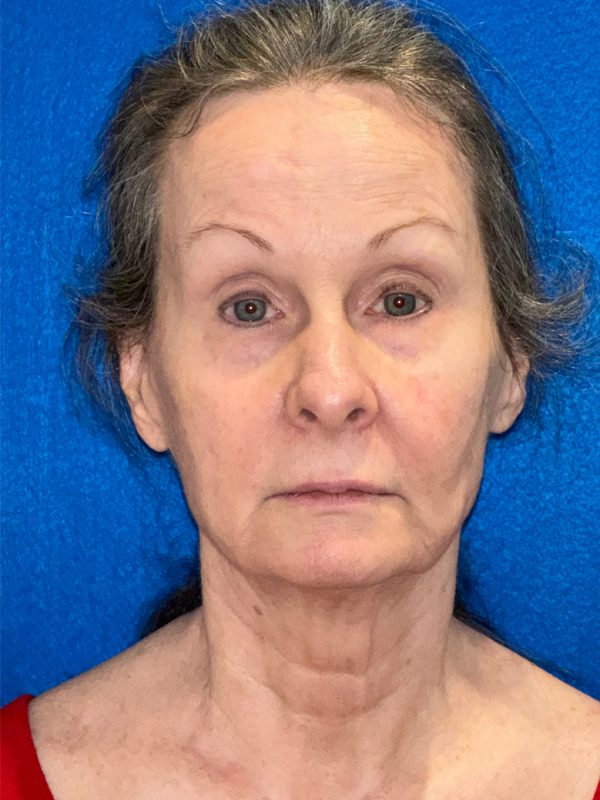 106281 Facelift c2 b1