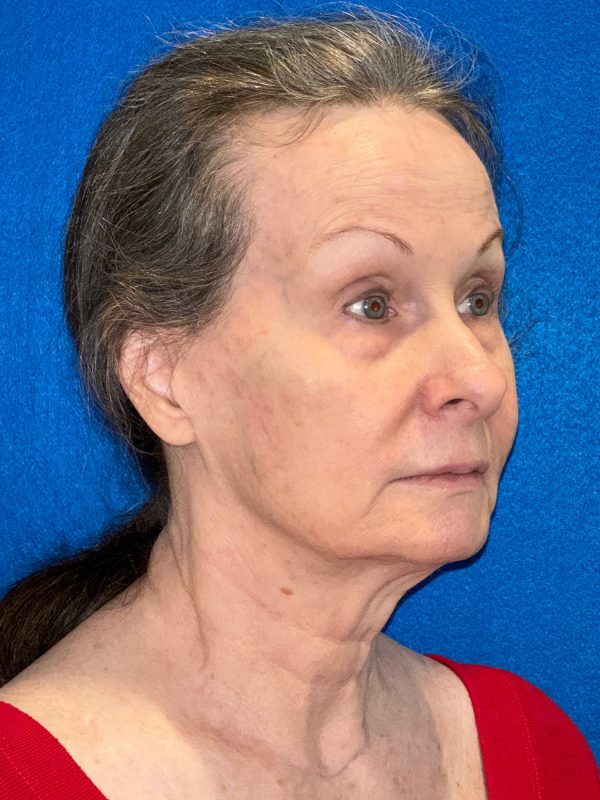 106281 Facelift c2 b2