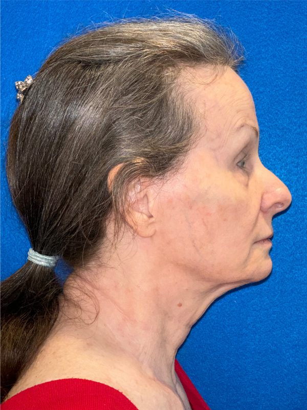 106281 Facelift c2 b3