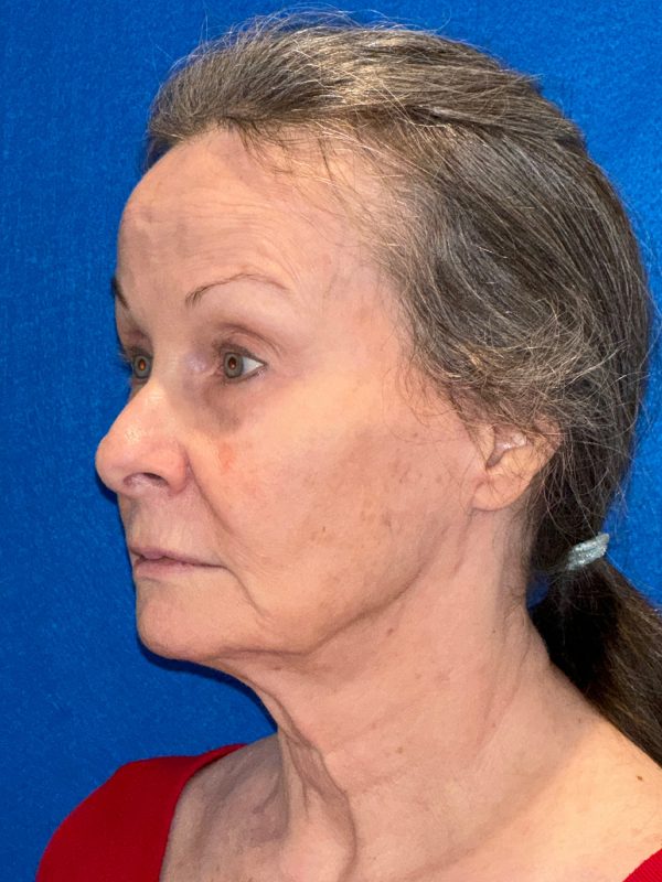 106281 Facelift c2 b4