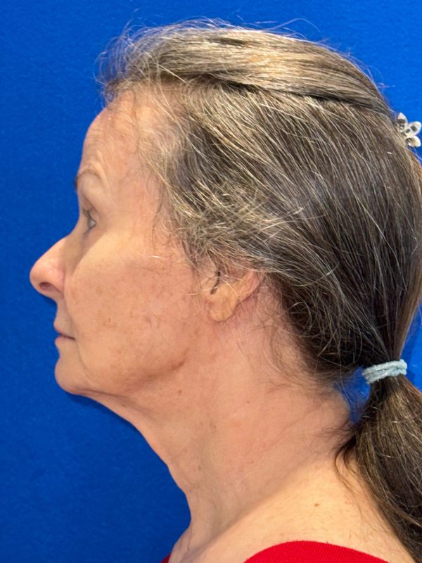 106281 Facelift c2 b5