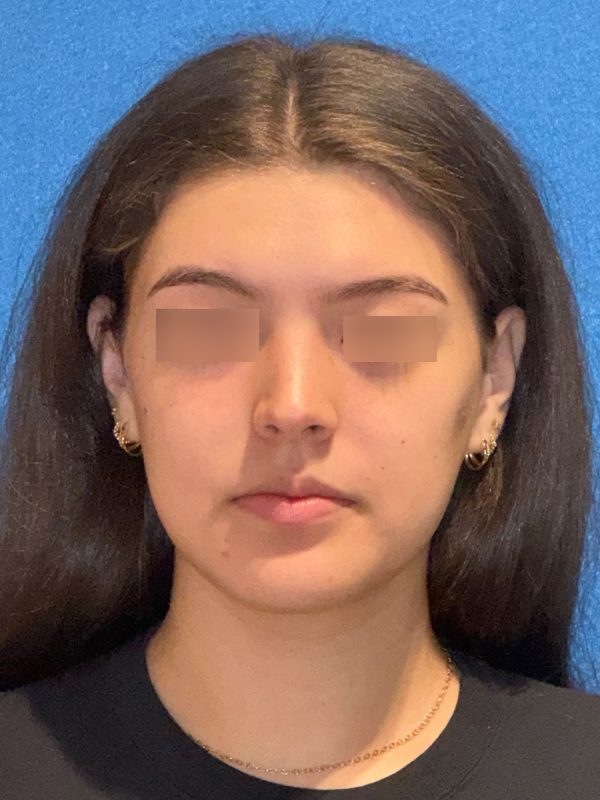 106281 Rhinoplasty c1 HB Post 1