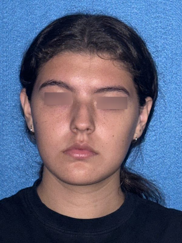 106281 Rhinoplasty c1 HB Pre 1