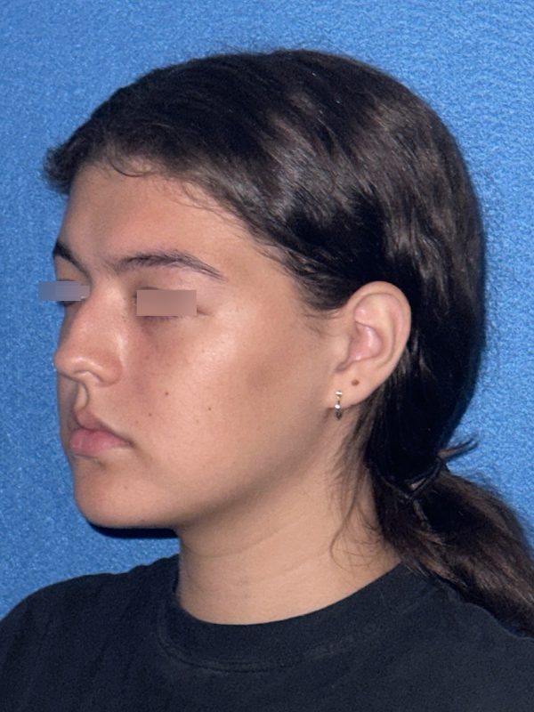 106281 Rhinoplasty c1 HB Pre 2