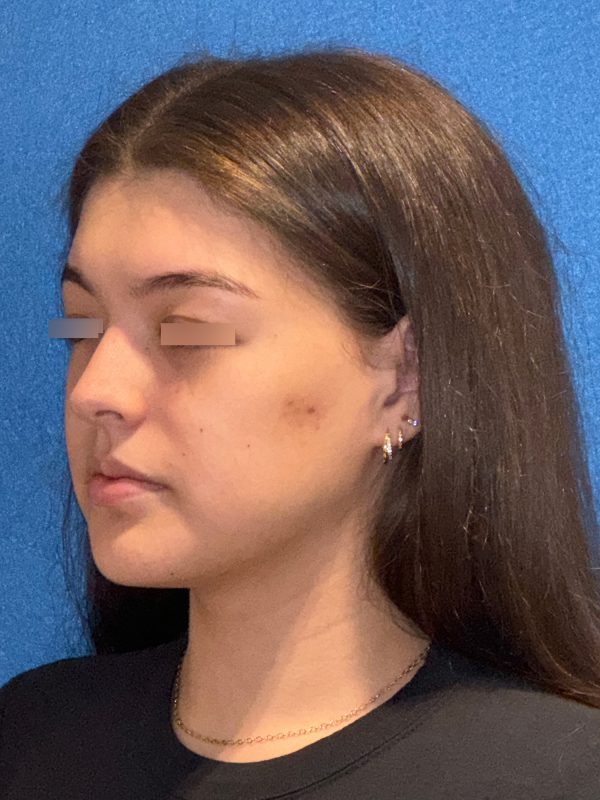 106281 Rhinoplasty c1 HB post 2 (2)