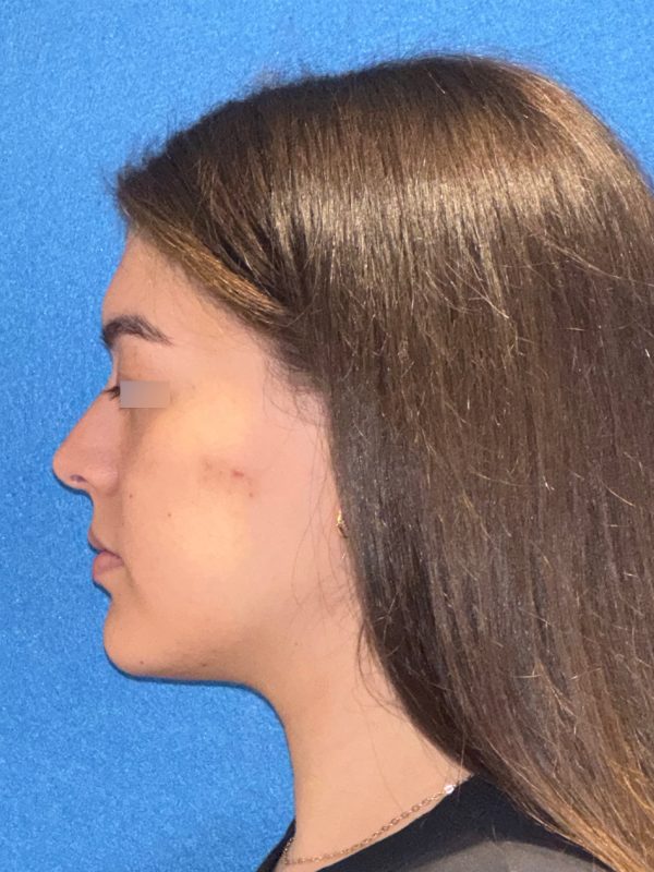 106281 Rhinoplasty c1 HB post 3