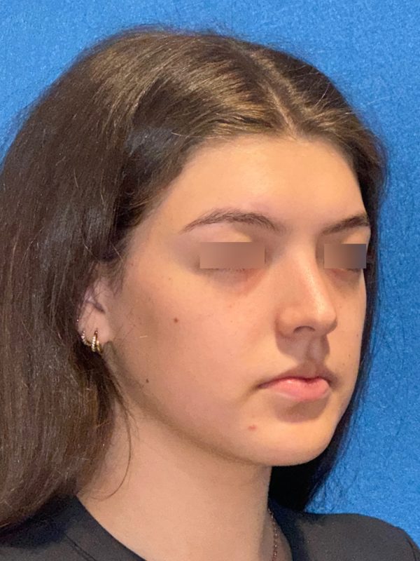 106281 Rhinoplasty c1 HB post 4 copy