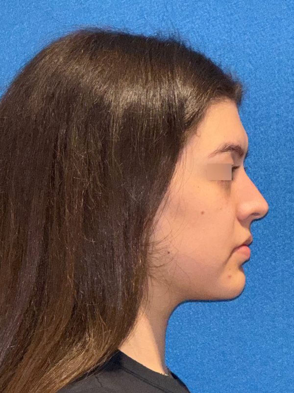 106281 Rhinoplasty c1 HB post 5