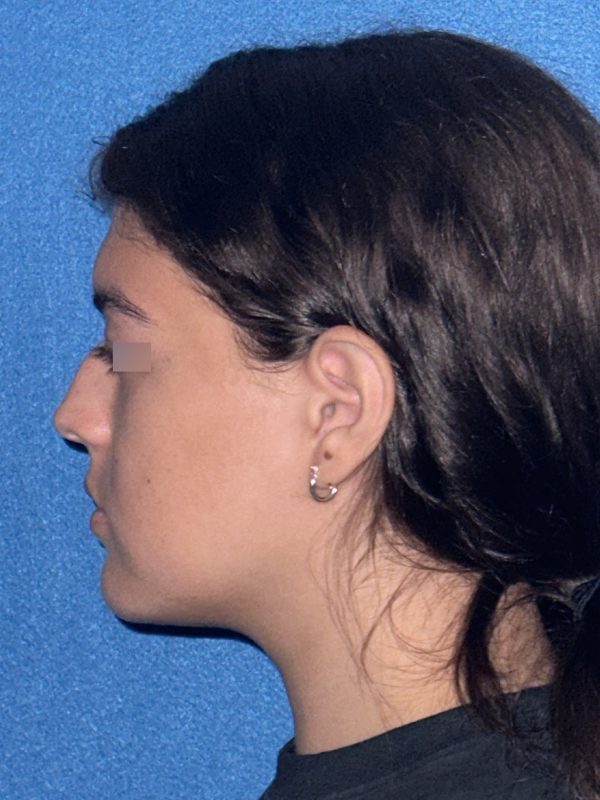 106281 Rhinoplasty c1 HB pre 3