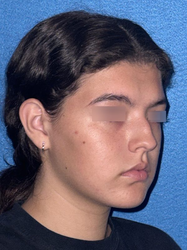 106281 Rhinoplasty c1 HB pre 4