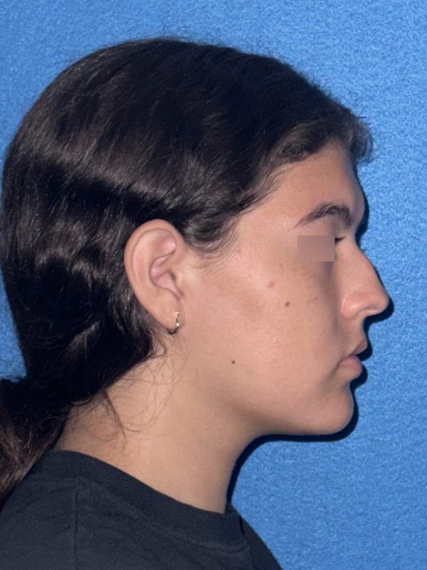 106281 Rhinoplasty c1 HB pre 5