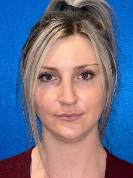 106281 Rhinoplasty c2 LF post 1