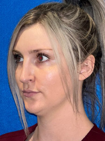 106281 Rhinoplasty c2 LF post 2