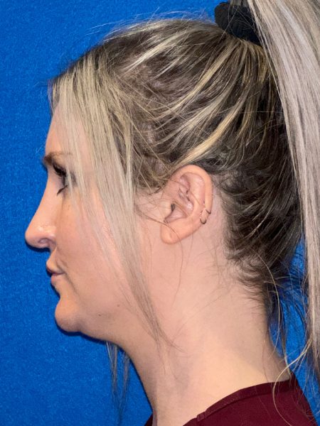 106281 Rhinoplasty c2 LF post 3