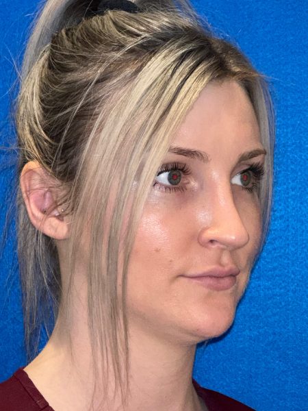 106281 Rhinoplasty c2 LF post 4