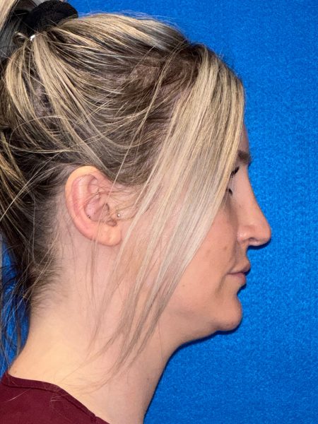 106281 Rhinoplasty c2 LF post 5